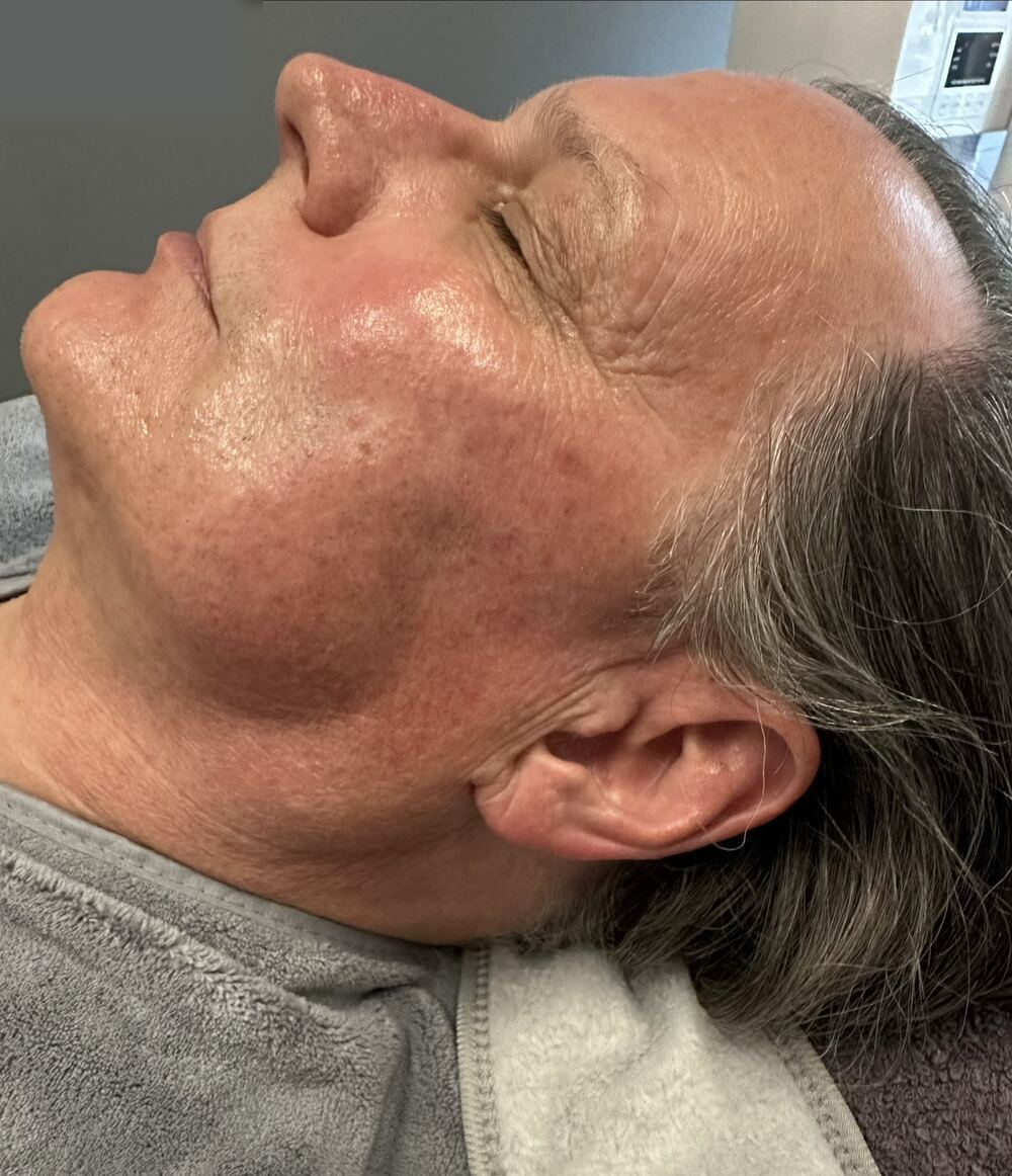 After treatment