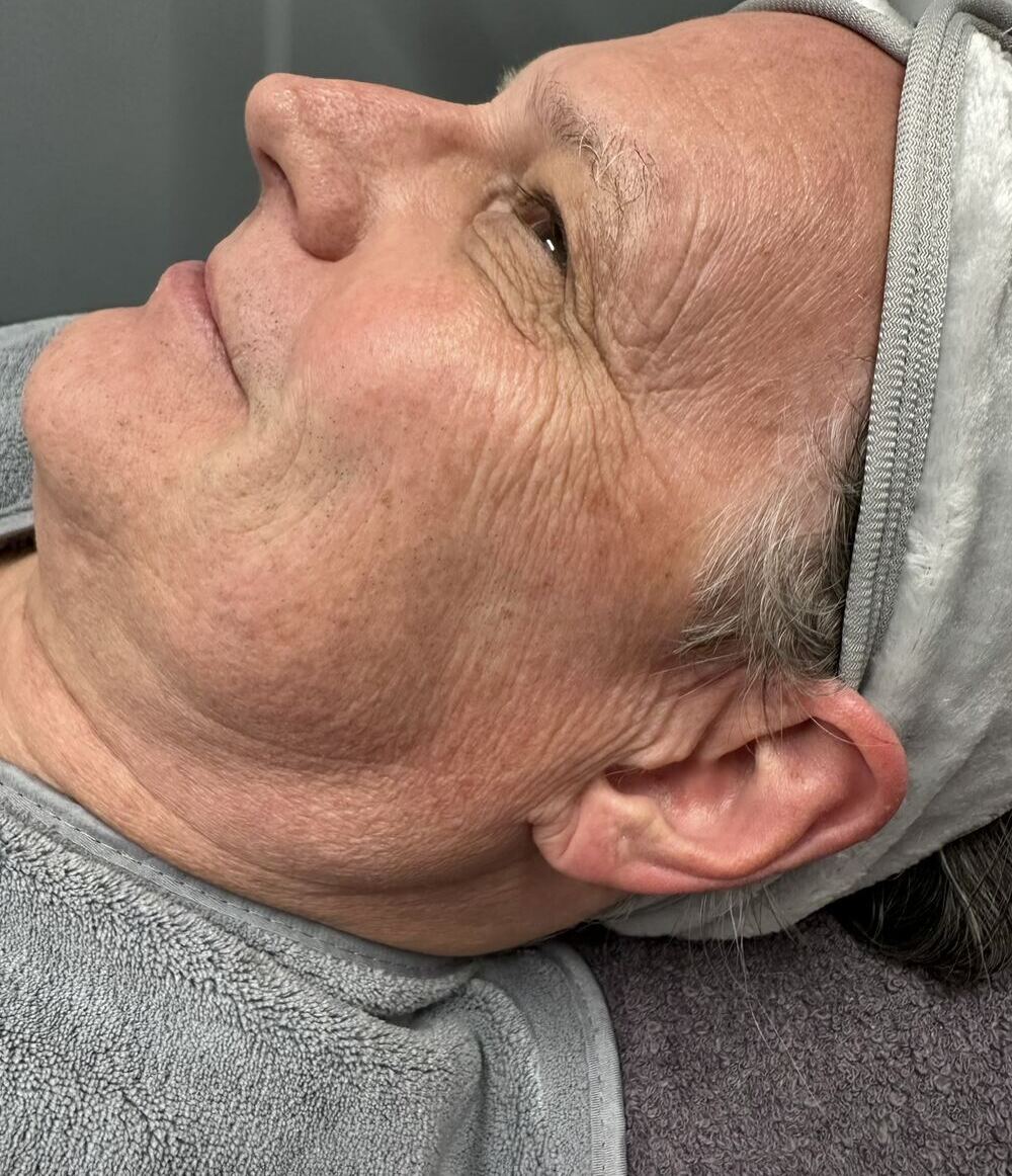 Before treatment