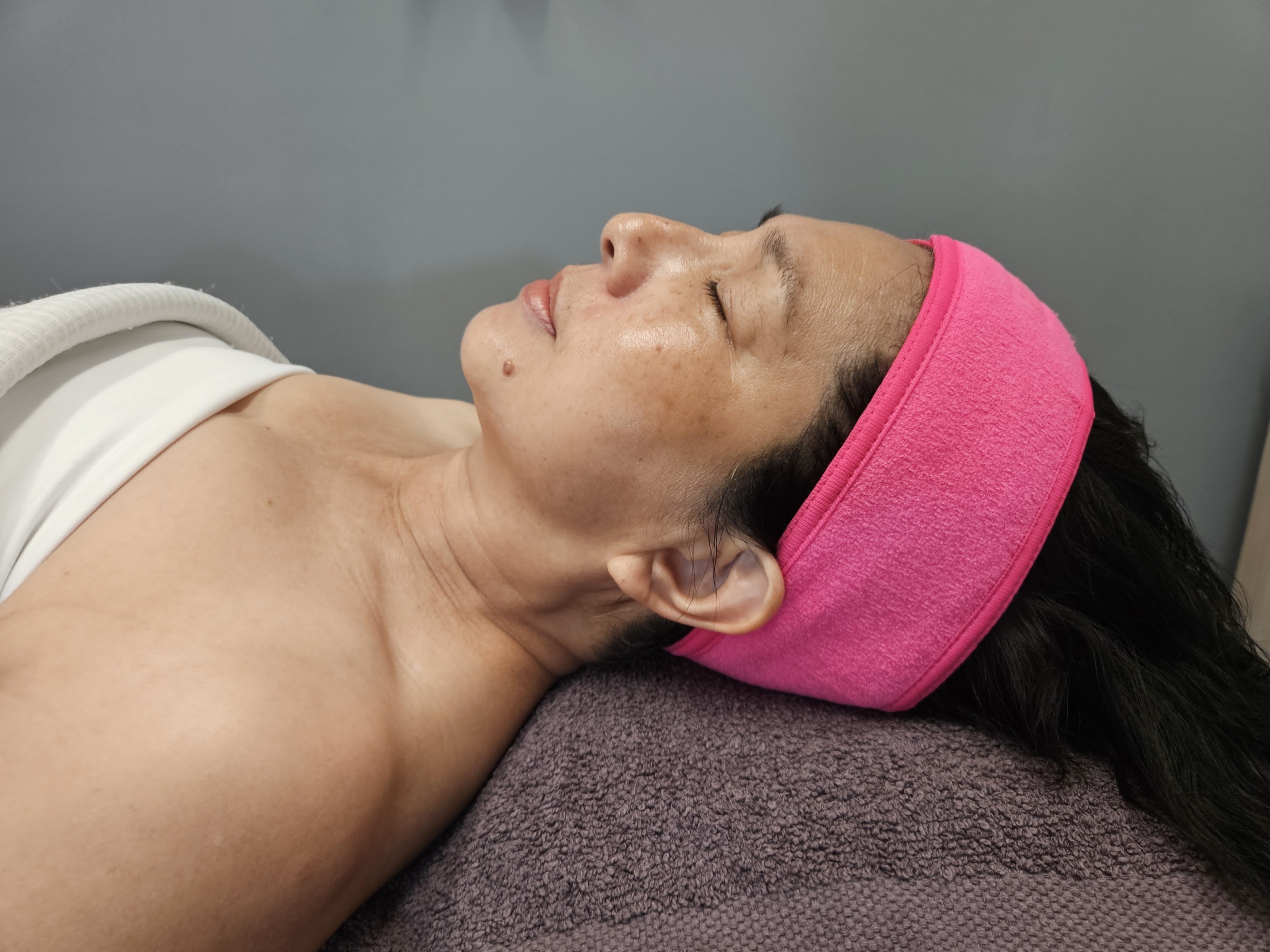 After treatment at Ageless Skin Studio