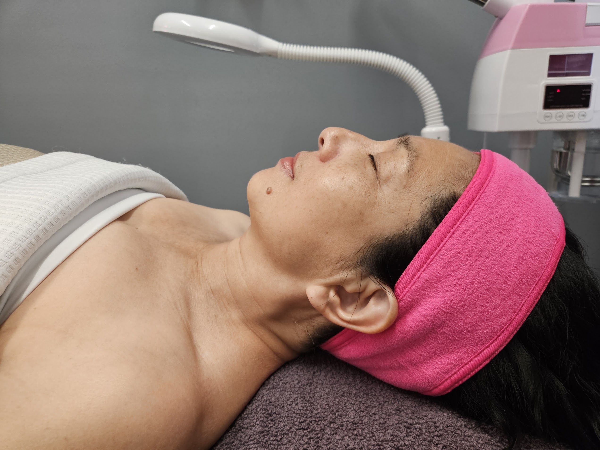 Before treatment at Ageless Skin Studio